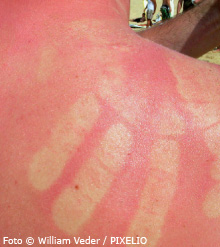 sonnenschutz-sonnenbrand